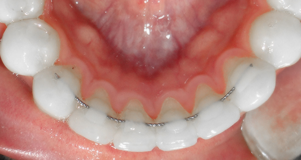 retenedores-ortodoncia